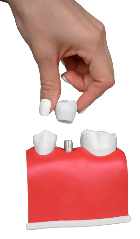 Dental Implant - Gobinda Dental Clinic - Dharan, Nepal